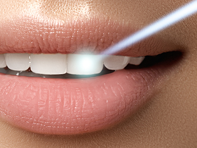 Crown Point Smiles | VELscope reg  Cancer Screening, Air Abrasion and ZOOM  Whitening